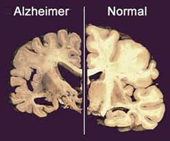 DOENÇA DE ALZHEIMER